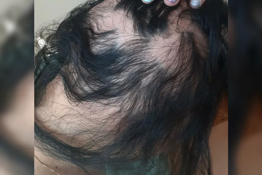 Alopecia: Jovem de Apucarana sofre com doença