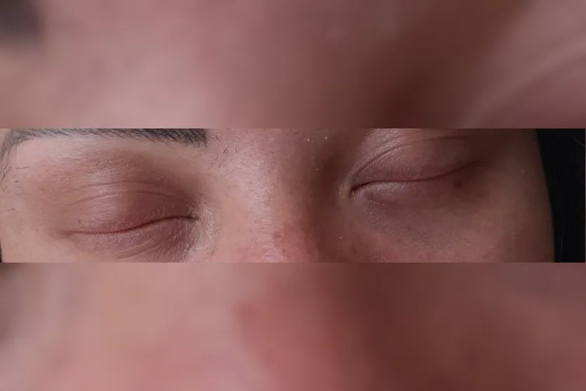 Alopecia: Jovem de Apucarana sofre com doença