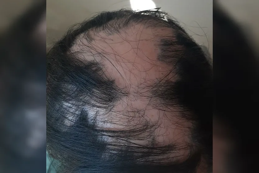 Alopecia: Jovem de Apucarana sofre com doença