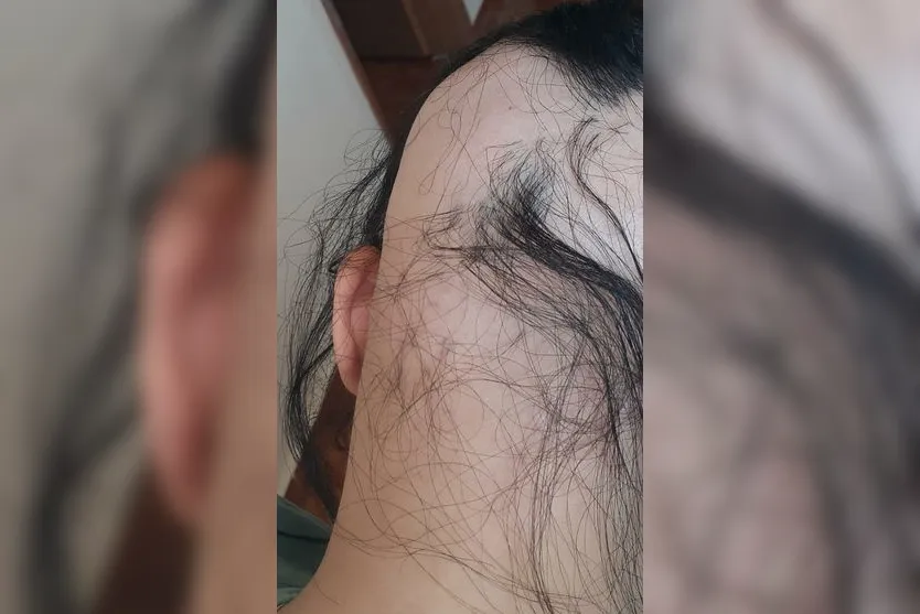 Alopecia: Jovem de Apucarana sofre com doença