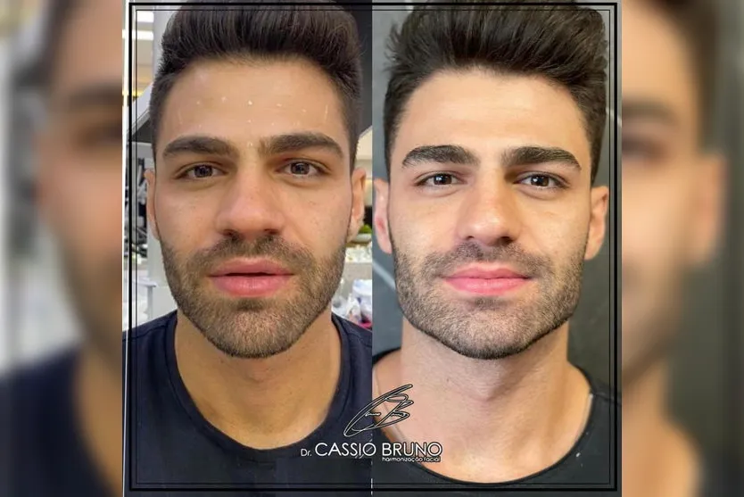 Dr. Cássio Bruno fala sobre o preenchimento de mandíbula