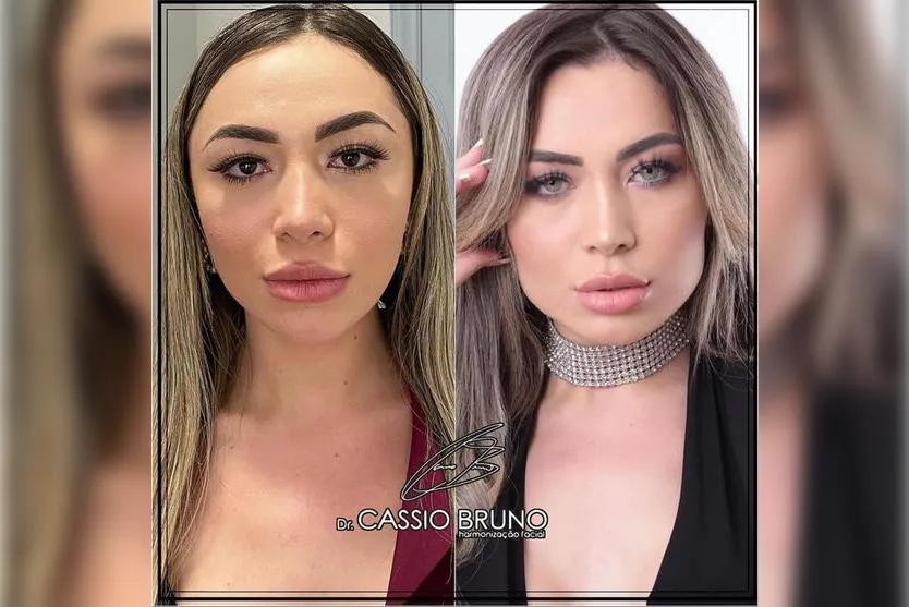 Dr. Cássio Bruno fala sobre o preenchimento de mandíbula