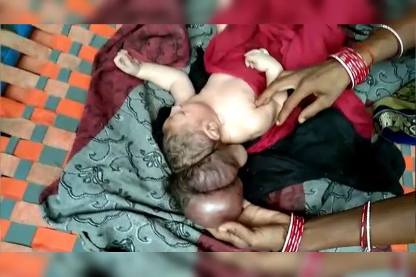 "Encarnação de Deus": bebê nasce com três cabeças na Índia