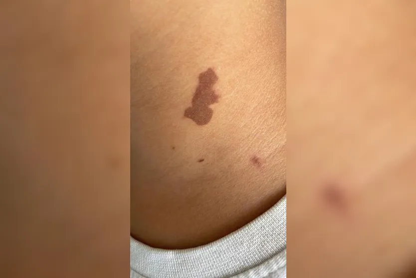 Criança tem queimadura de 2º grau ao ser atacada por besouro