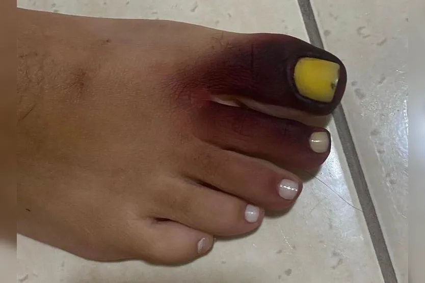 Mulher fica com pé roxo ao calçar tênis com piolho-de-cobra