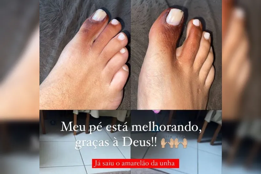 Mulher fica com pé roxo ao calçar tênis com piolho-de-cobra