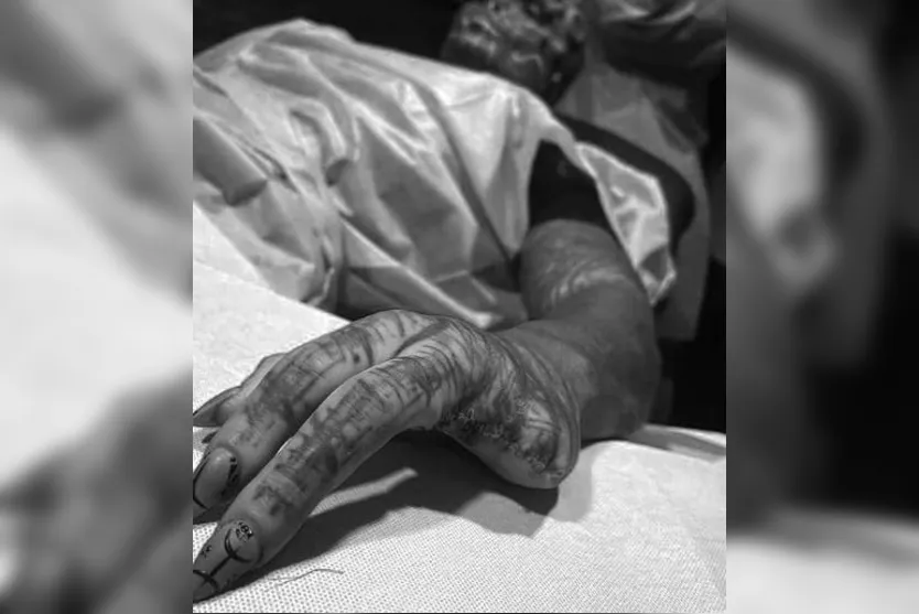 Homem tatuado amputa dedos para se parecer com alienígena