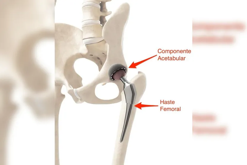 Apucaranense cria 'vaquinha' para pagar cirurgia no quadril
