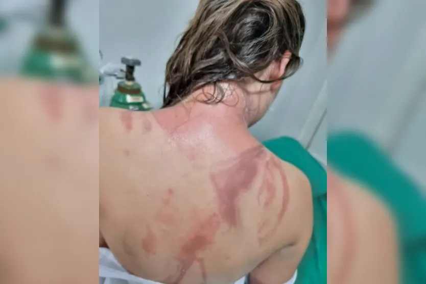 Calouros da UFPR são queimados com creolina durante trote