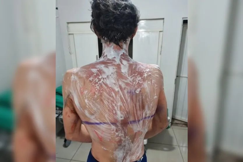 Calouros da UFPR são queimados com creolina durante trote