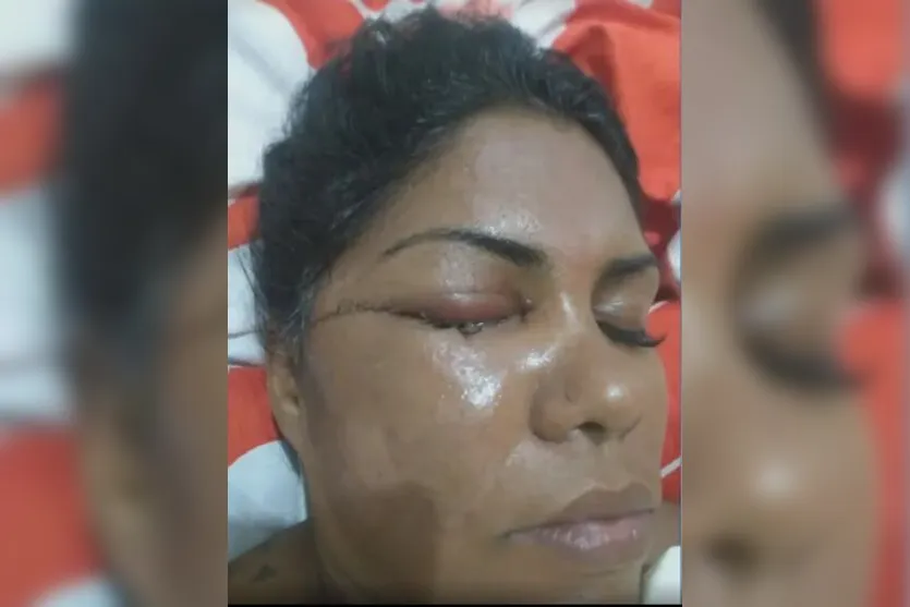  Bruna perdeu a visão do olho direito após ser atacada por um desconhecido 