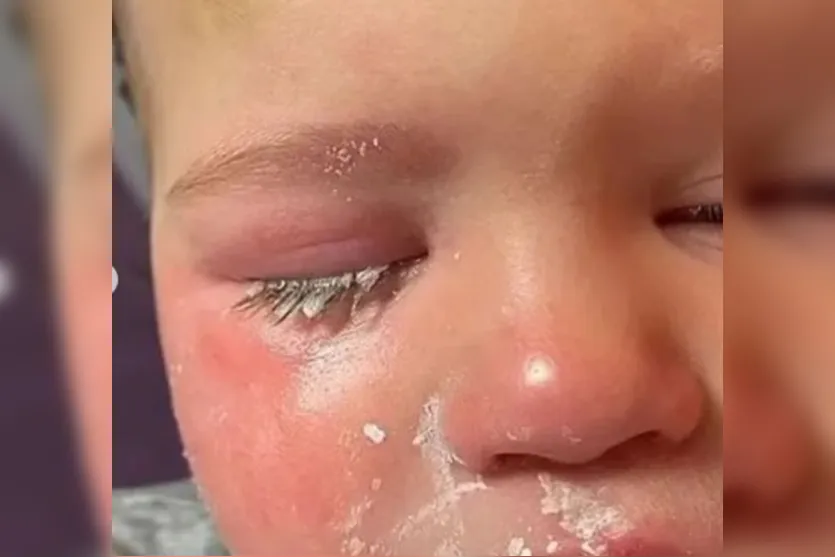 Funcionária de creche derruba cola no olho de bebê de um ano