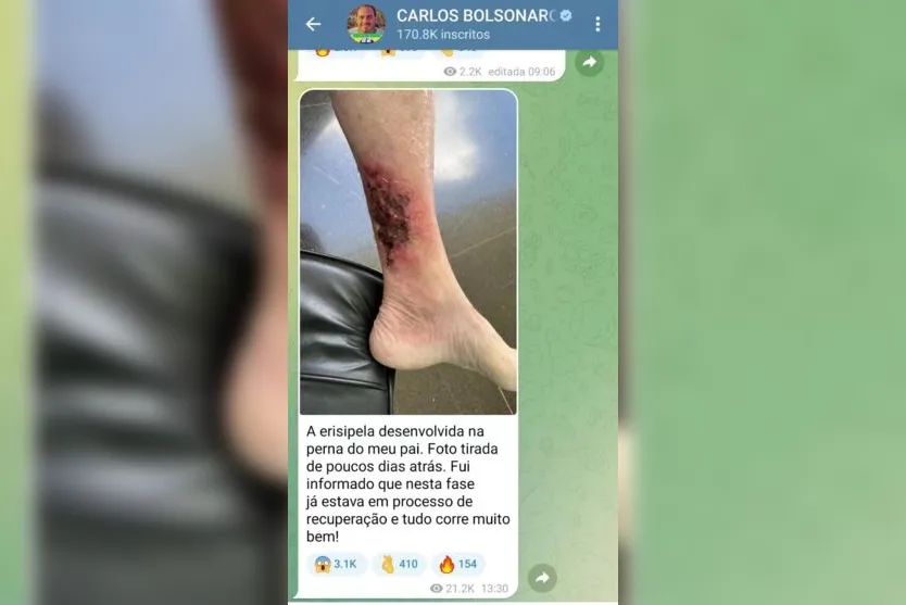 Erisipela: Carlos posta foto da perna de Bolsonaro com doença cutânea