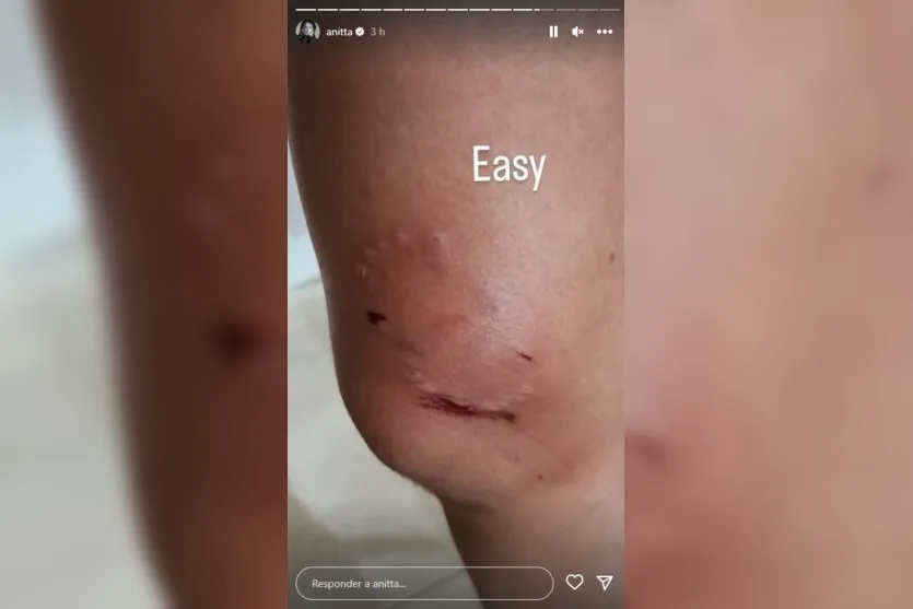 Anitta é mordida por cachorros ao tentar separar briga; veja imagens