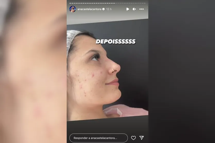 Ana Castela faz procedimento no nariz e mostra resultado; confira