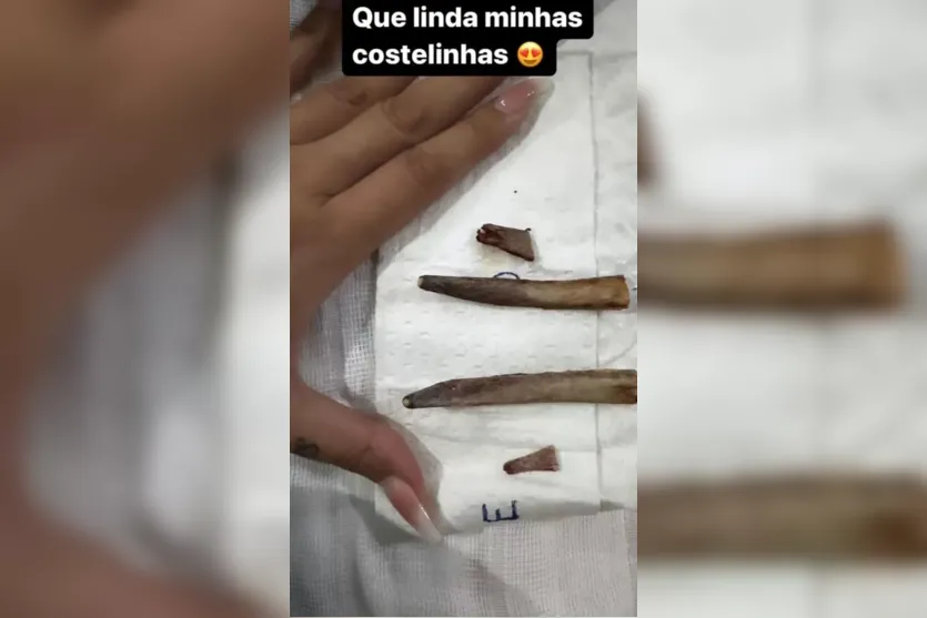 Andressa Urach faz procedimento para retirada parcial das costelas