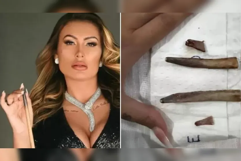  Andressa Urach mostrou costelas retiradas após cirurgia 