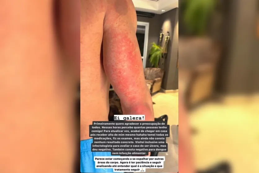 Influencer é internado com manchas no corpo; médicos não sabem o que é