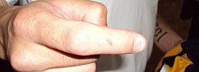  Herói do Boca mostra dedo inchado por mordida de rival 