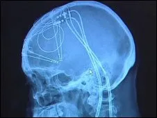  Técnica envolveu o implante de fios e eletrodos no cérebro da paciente