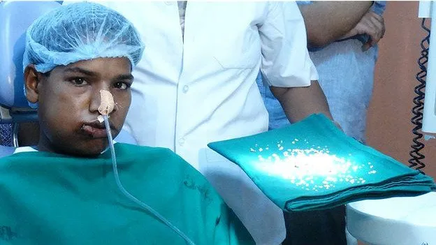Médicos removem mais de 200 dentes da boca de indiano