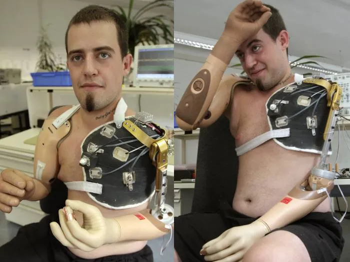  Austríaco de 22 anos teve os braços amputados em acidente