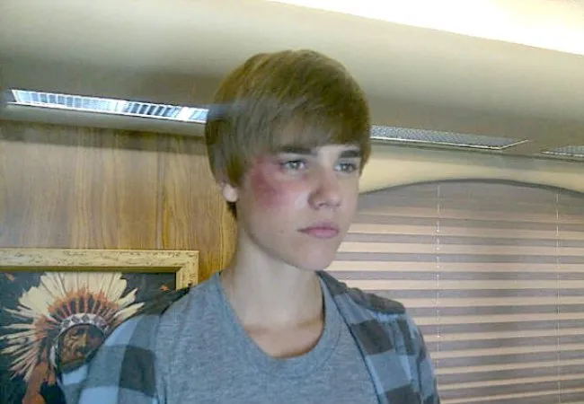 Justin Bieber apareceu em uma imagem com o olho roxo