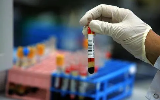  Exame de sangue pode detectar  a síndrome de Dow