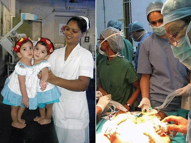 Médicos realizam cirurgia para separar Gêmeas siamesas 