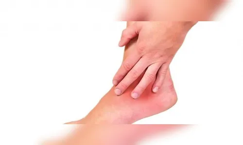 Dia Mundial de Combate à Trombose: saiba o que é mito ou verdade 