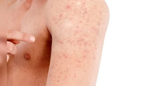 Como saber se é psoríase ou dermatite?