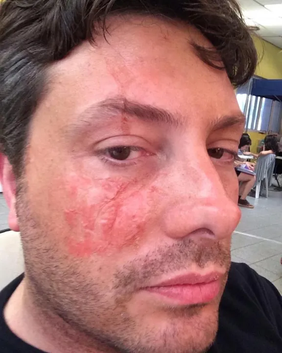 Danilo Gentili sofre acidente e posta foto com rosto queimado