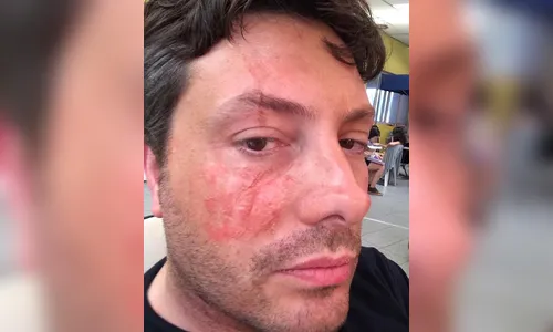 Danilo Gentili sofre acidente e posta foto com rosto queimado