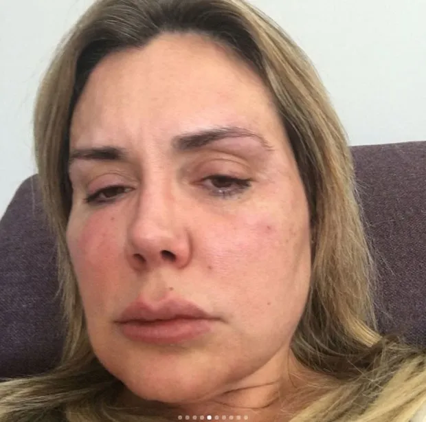 Renata Banhara com o rosto inchado durante tratamento (Foto: Reprodução/Instagram)
