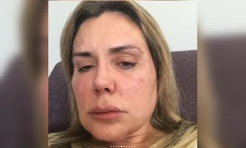 Após infecção, Renata Banhara diz que pensa em se matar