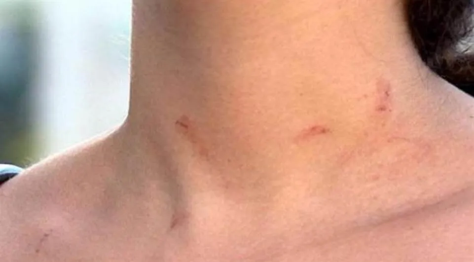 Marcas da agressão no corpo da professora: violência em sala de aula - Foto: Catve.com