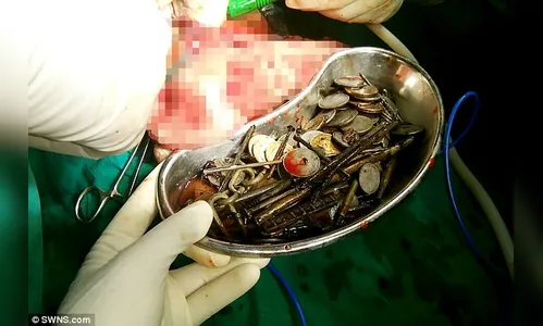 Médicos retiram 263 moedas , 1,5 kg de pregos, lâminas de barbear e pedaços de vidro do estômago de homem