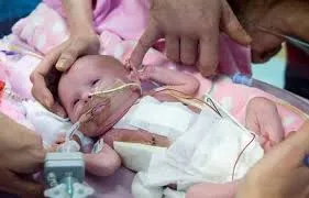 Menina com coração fora do corpo nasceu no Reino Unido - Foto: Reprodução The Guardian
