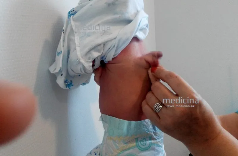 Bebê nasce com pênis extra nas costas e médicos ficam intrigados - Foto: site Medicina.az​
