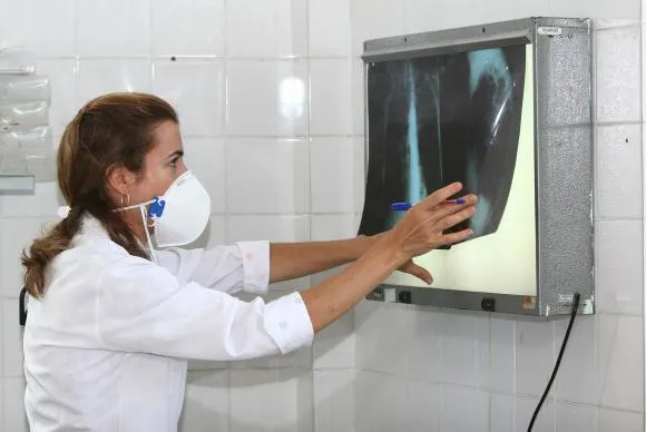 É necessário ficar atento aos sintomas da tuberculose para dar início ao tratamento e, com isso, interromper a contaminação das outras pessoas. Agecom Bahia