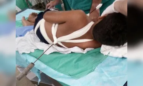 Menino de 11 anos sobrevive após espeto de churrasco perfurar coração