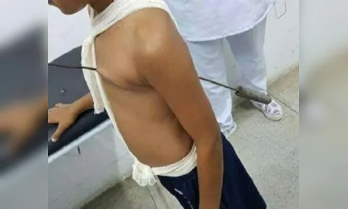 
							Menino de 11 anos sobrevive após espeto de churrasco perfurar coração
						
						