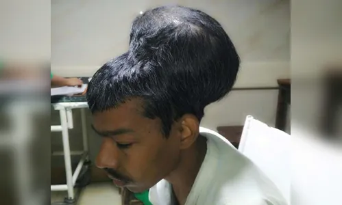 Paciente indiano sobrevive à extração de tumor cerebral de quase 2 kg