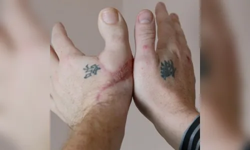 Já imaginou como seria ter um dedo do pé na sua mão; veja o vídeo