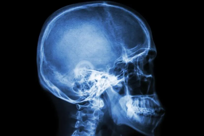 Os médicos só perceberam o erro quando não conseguiram encontrar o coágulo na cabeça do paciente - imagem metropoles
