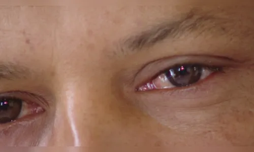 
							Surto de conjuntivite afeta 647 pessoas e acaba com estoque de colírios em Cianorte
						
						