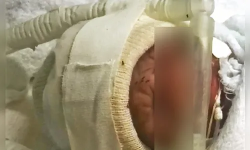 Formigas atacam bebês em incubadora neonatal