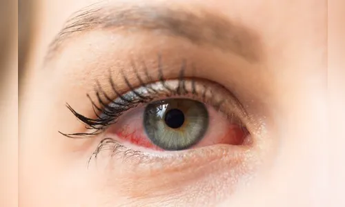   Hospital da Providência orienta sobre conjuntivite