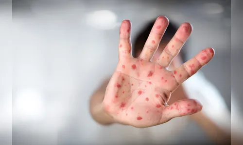 São Paulo registra a primeira morte por sarampo em 2020