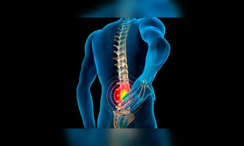 Vida Saudável: como tratar a hérnia de disco
